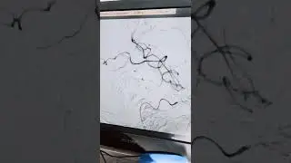 Как оперируют инсульт