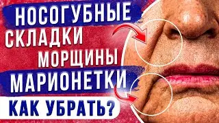 Носогубные складки и морщины марионетки. Что с ними делать?