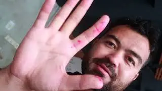 My hand started bleeding in Seminyank Beach  Bali