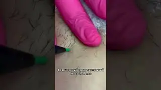 Хотим развеять миф о том что электроэпиляция это больно