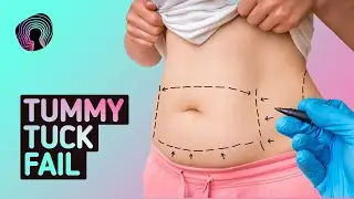 They Botched My Tummy Tuck