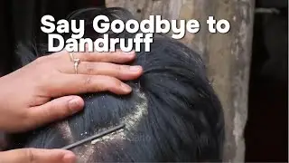 Flake-Free Forever: The Ultimate Dandruff Removal Guide! #AST01