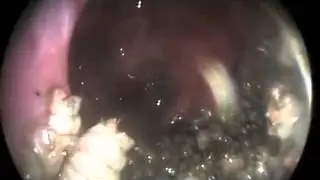 Nasal Myiasis | NEJM