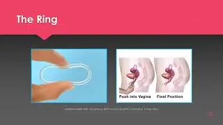Teens, Pregnancy, and Birth Control video