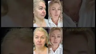 Голливудский фейслифтинг. Подтяжка лица. Пластическая операция