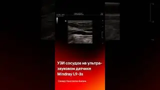 Визуализация сосудов на датчике УЗИ Mindray L9-3s 