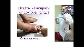 Отёки на ногах