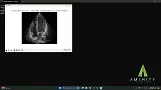 EchoTracker: Revolutionizing Tissue Tracking in Echocardiography