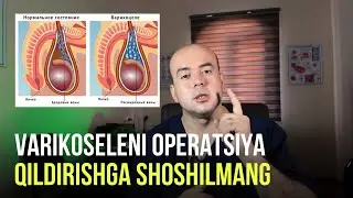 VARIKOSELENI OPERATSIYA QILDIRISHGA SHOSHILMANG