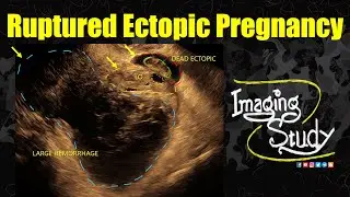 Ruptured Ectopic Pregnancy || TVS || Ultrasound || Case 344