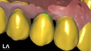 FULL MOUTH Digital Wax-up with Exocad