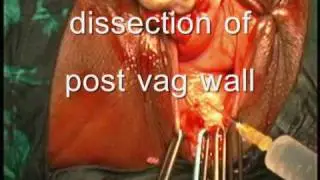 vaginal hysterectomy,prolapse,ss colpopexy,mesh,pelvic floor repair,dr c v hegde,mumbai.wmv