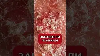 Заразен ли псориаз? 