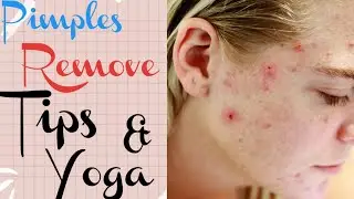 Pimples Remove Tips & Yoga | #pimples #beauty  #tips  @Fitness-is-life