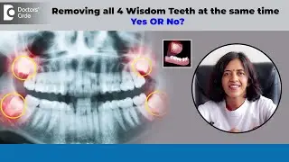 4 Wisdom Teeth Removed in 1 DAY - Yes or No?|3rd molar Extraction-Dr.Lakshmi Roopesh|Doctors' Circle