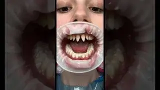 ЗАЧЕМ я ИСПОРТИЛА ЗУБЫ?