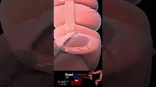 hemicolectomy surgery medical arts
