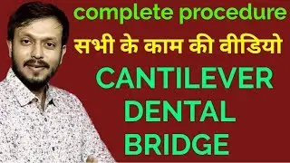 CANTILEVER DENTAL BRIDGE TO REPLACE MISSING TOOTH || tooth cap Bridge ||