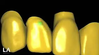 Esthetic Eggshell Provisional in EXOCAD