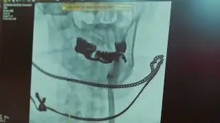 Причина инсульта