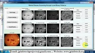 Retinal Disease Screening through Local Binary Patterns | Matlab IEEE Final Year Project