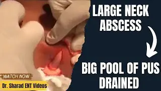 LARGE NECK ABSCESS || BIG POOL OF PUS DRAINED FROM THE NECK || Incision and Drainage || DRAINING PUS