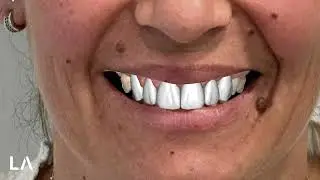 Smile Creator and Digital Wax-up in EXOCAD Case 5