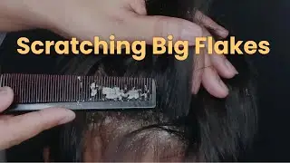Ultimate Dandruff Scratching! Big Flakes Removed for Instant Relief 🧖‍♀️✨