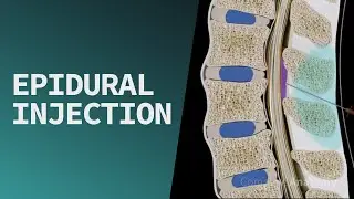 Epidural Injection