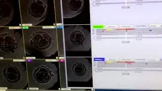 how to use time lapse in embryo selection