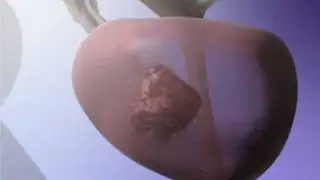 Prostate Cancer