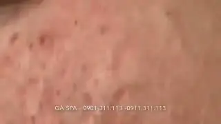 НОВОЕ Удаление и выдавливание чёрных точек! Чистка лица! Прыщи - выдавливание! Удаление прыщей!
