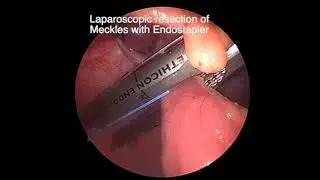 Laparoscopic resection of Meckles diverticulum using endostapler along with appendicectomy.