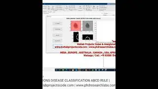 SKIN LESIONS DISEASE CLASSIFICATION ABCD RULE