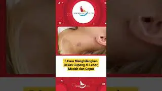 Cara Ampuh Menghilangkan Bekas Cupang di Leher, Mudah dan Cepat  