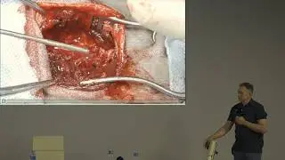 Болезни дисков как лечить как оперировать