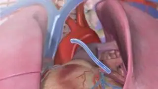 CABG