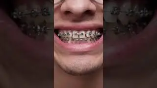 5 Month Braces Progress 🤯