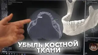 Убыль костной ткани по причине отсутствующих зубов