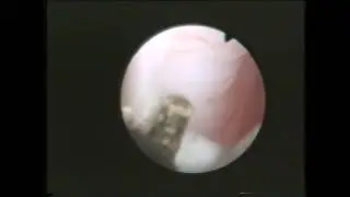 Cystoscopy with division of posterior urethral valve in a small child