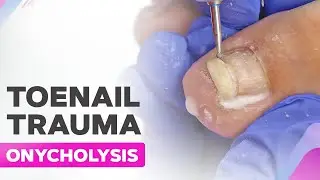 Toenail Trauma | Onycholysis | Cleanup