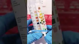 Urinalysis results showing Red blood cells in urine Hematuria 
