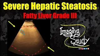 Severe Hepatic Steatosis | Grade III Fatty Liver || Ultrasound || Case 348