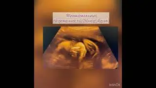 миома матки и беременность 😨