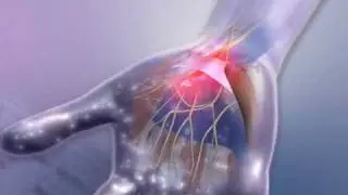 Carpal Tunnel