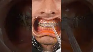 How to clean braces