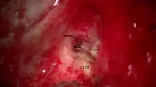 CSF (brain fluid) leak repair