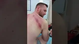 Работа со шрамом, баночный массаж