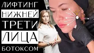 Лифтинг нижней трети лица ботоксом