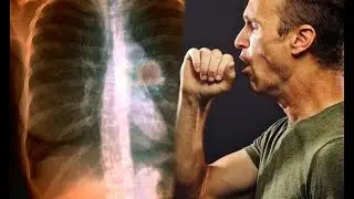 5 Signs Your Lungs Are Gasping for Help